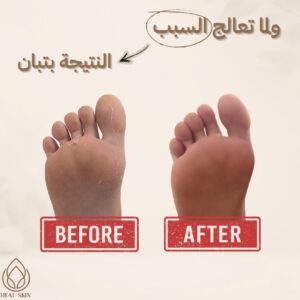 رزمة علامات التمدد+ رزمة رائحة القدمين+ سيروم الاظافر