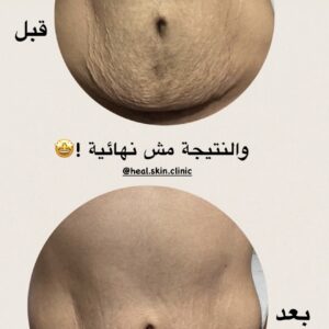 رزمتين علامات التمدد x2