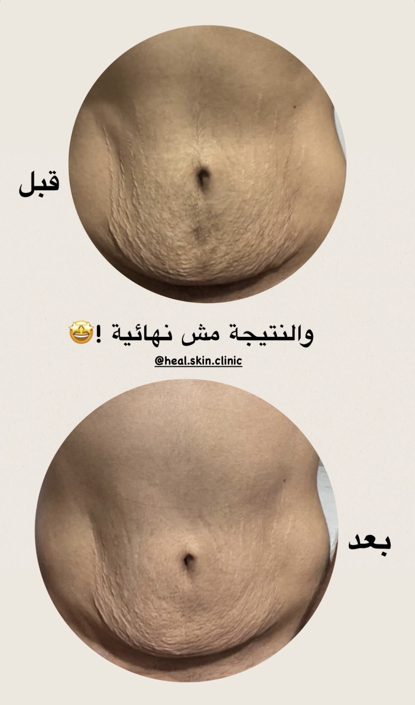 رزمتين علامات التمدد x2 - الصورة 2