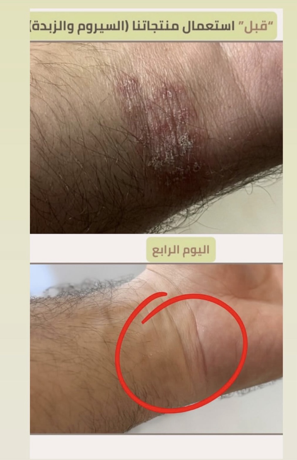رزمتين علامات التمدد x2 - الصورة 6